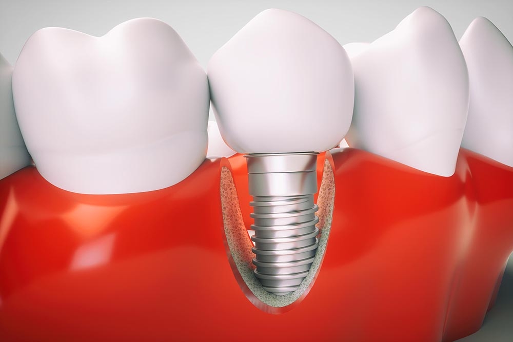 What is the success rate of dental implants for smokers?