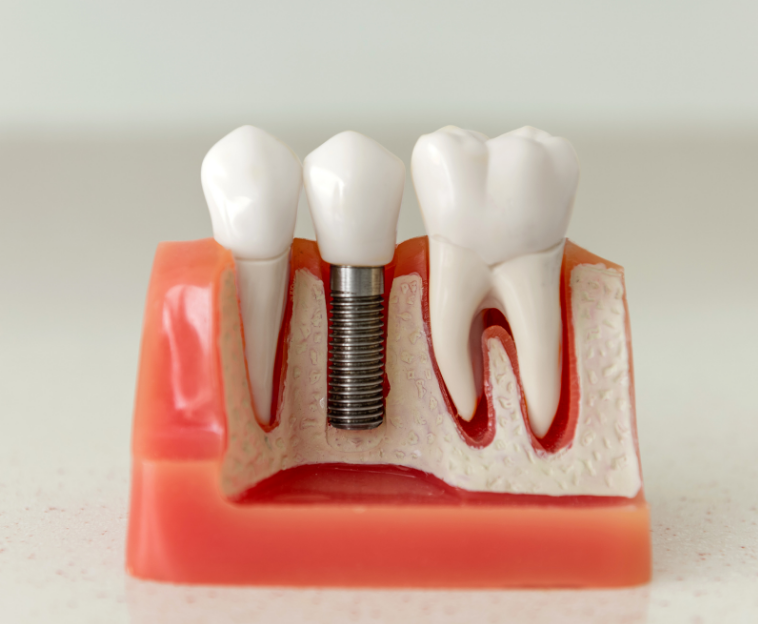 What Is The Success Rate Of Dental Implants For Smokers, Dental Implant Success Rate in Smokers, Success Rate of Dental Implants for Smokers, Dental Implant Success in Smokers, Smokers Dental Implant Success Rate, Dental Implant Outcome in Smokers, Dental Implant Effectiveness in Smokers, Dental Implant Results for Smokers, Dental Implant Efficiency in Smokers, Dental Implant Performance in Smokers, Dental Implant Efficacy in Smokers, Dental Implant Progress for Smokers, Dental Implant Achievement in Smokers, Dental Implant Triumph in Smokers, Dental Implant Victory in Smokers, Dental Implant Prosperity in Smokers, Dental Implant Accomplishment in Smokers, Dental Implant Attainment in Smokers, Dental Implant Prosperity in Smokers, Dental Implant Fulfillment in Smokers, Dental Implant Advancement in Smokers, Dental Implant Breakthrough in Smokers, Dental Implant Success Story for Smokers, Dental Implant Testimonials in Smokers, Dental Implant Experience in Smokers